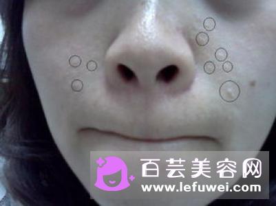 痘痘挤出来硬硬小米粒是螨虫吗 不要照镜子痘痘就会好