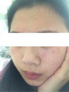刷酸会导致敏感肌肤嘛 刷酸后能见光吗