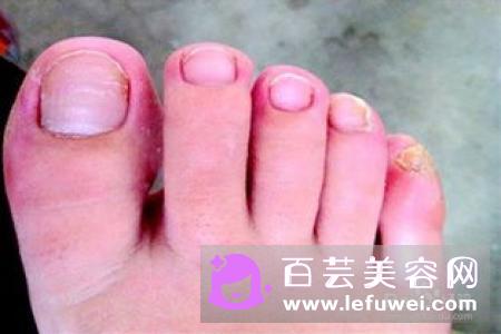 经常美甲会得灰指甲吗 什么人不能做美甲