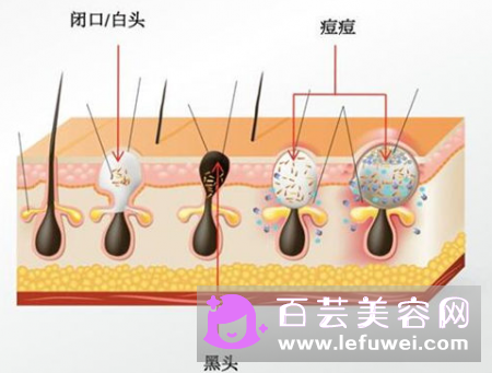 闭口粉刺如何快速消掉 和开口粉刺哪个可以挤出来