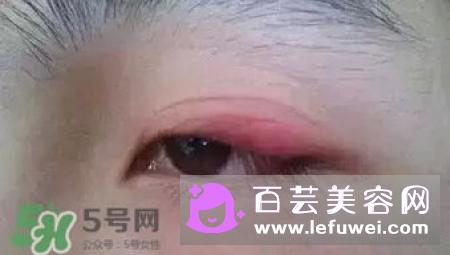 双眼皮贴过敏是什么原因过敏怎么办