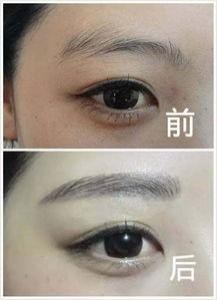 纹眉为什么会结痂了吧