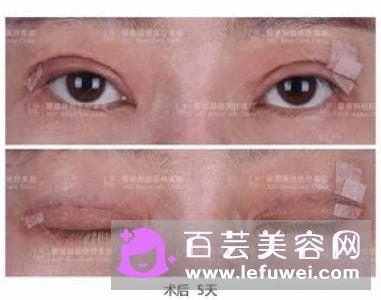 双眼皮贴过敏是什么原因过敏怎么办