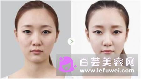 lacues瘦脸仪效果怎么样 和refa有什么区别