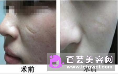 副乳切除要多少钱切除多久恢复