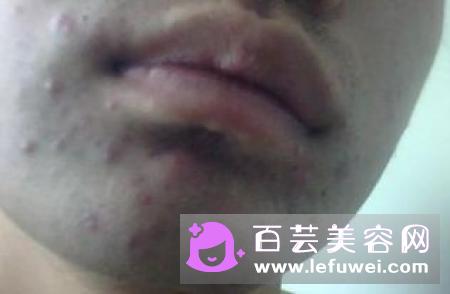 鼻子白头粉刺怎么去除 可以挤吗