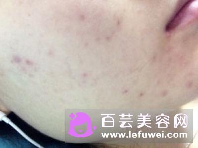红蓝光治痤疮需要几次 有哪些好处