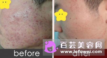 红蓝光治痤疮需要几次 有哪些好处