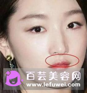 美瞳环状花纹适合什么人 放射状花纹适合什么人