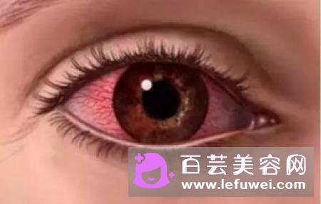 隐形眼镜是硬性好还是软性好 有什么区别